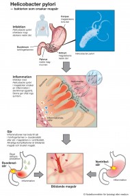 Helicobacter pylori (pdf 4.23 MB, ny flik).